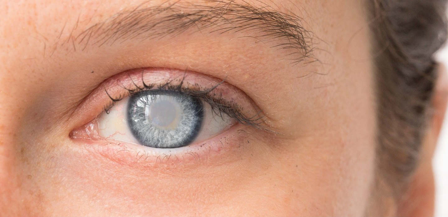 Как улучшить зрение при катаракте без операции